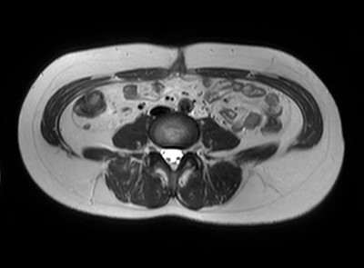 Postoperative MRI. Axial view.