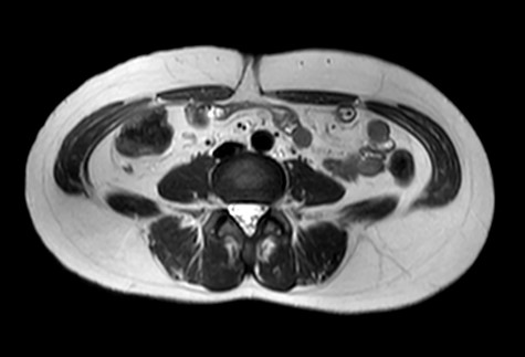 MRI axial view of the port site hernia.