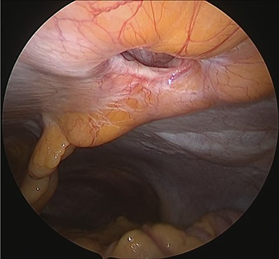 Hernia orifice.