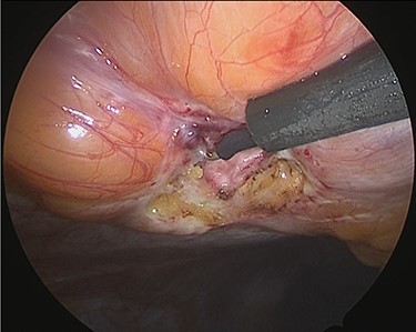 Exposure of the muscle layer around the hernia orifice.