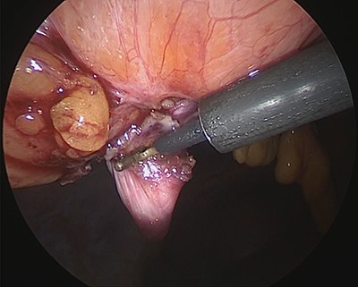 The hernia sac is excised.