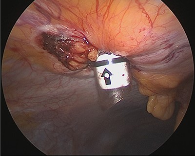 A 12-mm trocar is inserted into the hernia orifice.