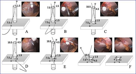 The VersaOneTM Fascial Closure System in use.