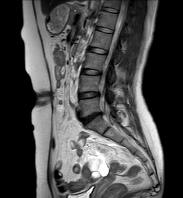 Postoperative MRI. Sagittal view.