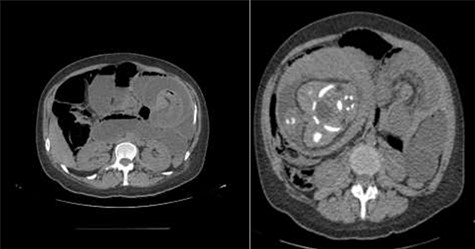 Axial view of the CT scan showing jejunojejunal intussusception with fat and blood vessels within the lumen of intestine (white arrow—typical “target sign”).