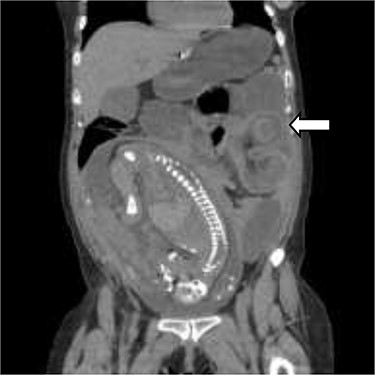 Coronal view of the CT scan showing intussusception (white arrow—sausage-shaped thickened bowel Wall).