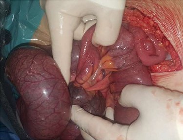 Retrograde intussusception of the common limb into the jejunojejunostomy.