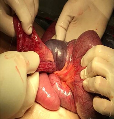 Intussusception reduction.