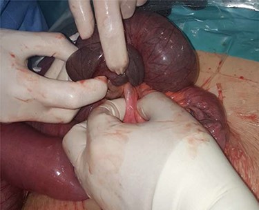 Intussusception reduction.