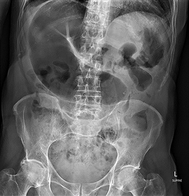 Abdominal X-ray on presentation showing a distended loop of colon with air-fluid levels.