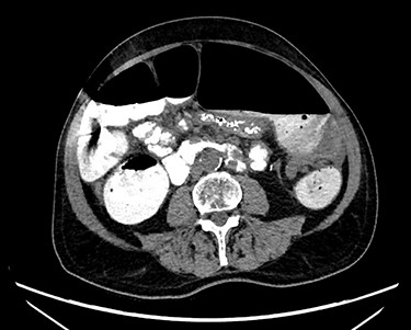 CT scan demonstrating a dilated colonic loop with air-fluid levels and swirling of the mesentery, indicative of a large bowel obstruction secondary to a volvulus.