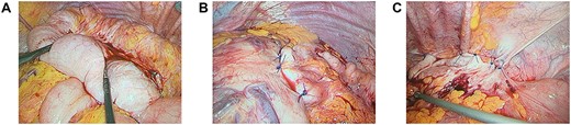 (A) Neo-left colonic volvulus forming an alpha-type loop; (B) pexy of the neo-left colon to the posterior stomach wall using interrupted prolene sutures; (C) pexy of the neo-left colon to the left lateral abdominal wall using interrupted prolene sutures