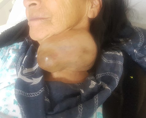 Firm mass approximately 15 cm in diameter with irregular margins located in deep tissue on the left lobe of the thyroid.