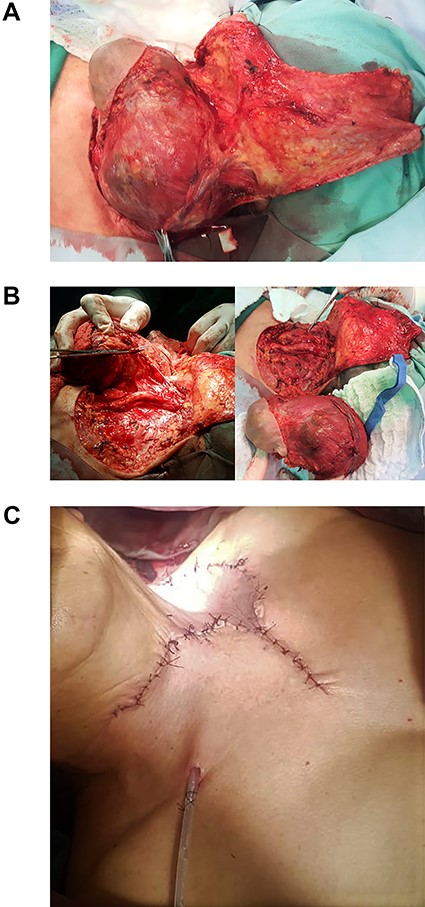 (A) Atrophic skin, lymph node tumor invading the jugular vein, sternocleidomastoid and omohyoid muscles, and ipsilateral spinal nerve. (B) Classic radical dissection. Surgical specimen. (C) Advancement flap.