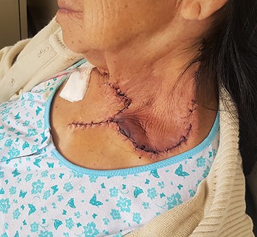 The flap was well perfused at 24 hours postoperatively. The patient presented left shoulder drop.