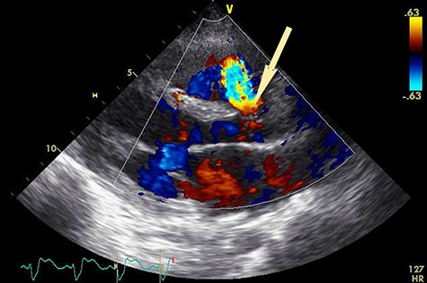 Preoperative transthoracic echocardiogram. Shunt flow (arrow) from aorta to RV.