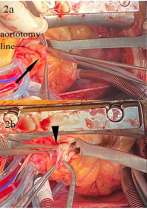 Intraoperative images; (a) SVA (arrow); (b) the rupture site (arrowhead) of SVA; forceps are inserted into the ruptured hole.
