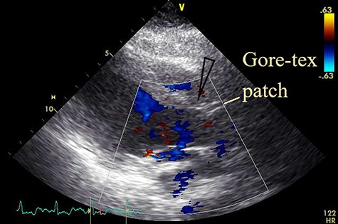 Postoperative transthoracic echocardiogram; the view after patch closure by Gore-tex® 0.4-mm patch with no shunt flow (open arrowhead).