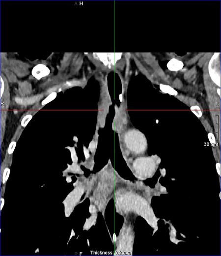 Coronal reconstruction post contrast CT neck and thorax images with 4 mm defect/tracheoesophageal fistula located 8–9 cm from tracheostomy level and 12 cm proximal to the carina.
