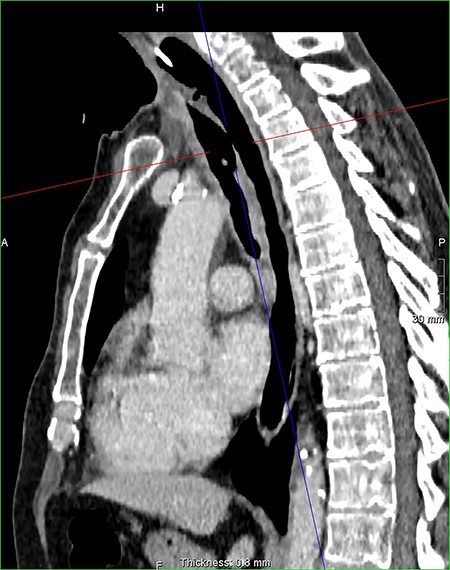 Sagital reconstruction post contrast CT neck and thorax images with 4 mm defect/tracheoesophageal fistula located 8–9 cm from tracheostomy level and 12 cm proximal to the carina.