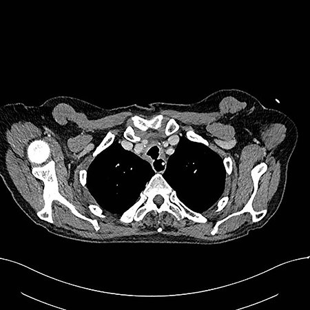 Axial reconstruction post contrast CT neck and thorax images with 4 mm defect/tracheoesophageal fistula located 8–9 cm from tracheostomy level and 12 cm proximal to the carina.