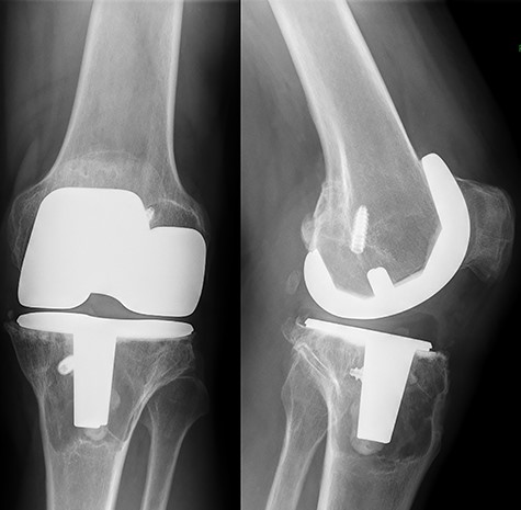 Preoperative standing X-ray of the left knee. A large lytic lesion is seen surrounding the tibial component.