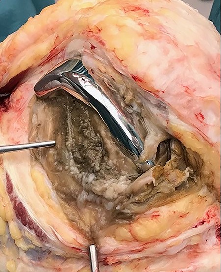 Intraoperatively gray staining of the synovium was encountered.