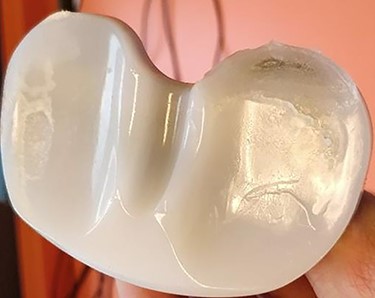 The tibial bearing showed wear mainly involving the posterolateral corner.