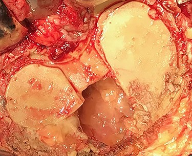 After removal of tibial component a large pseudotumor was observed in the proximal tiba.