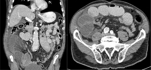 CT: demonstrates closed loop short bowel obstruction with dilated small-bowel loops and ascites