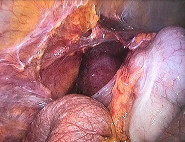 ischemic intestine visible through the incised connections of coecum to the abdominal wall during laparoscopy