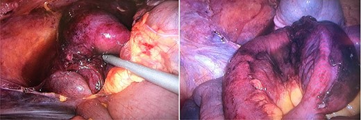 perioperative pictures of the pericecal internal hernia and the necrotic small bowel