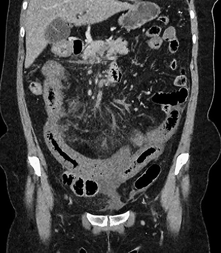 CT showing multiple thick-walled, non-enhancing loops of small bowel.