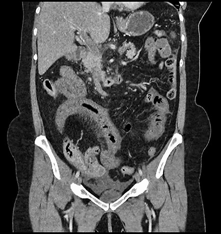 CT showing complete occlusion of the portal vein at the level of the porta hepatis.
