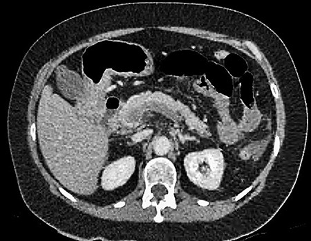 CT showing thrombosis of the splenic vein behind the pancreas.