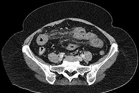 CT showing multiple thick-walled loops of jejunum.