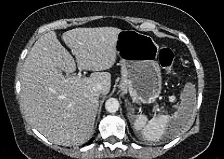 CT showing an area of splenic infarction due to venous ischaemia.