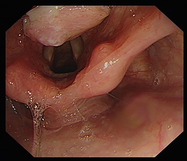 endoscopic image demonstrating ulcerative growth on the laryngeal surface of the epiglottis.