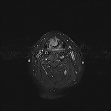 axial MRI T1FS with gadolinium image with 16 × 15 × 12 mm almost rounded well defined and enhancing lesion related to the base of epiglottis with no definite involvement of the tongue base.