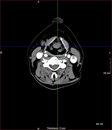 axial postcontrast CT images of the neck with similar lesion related to the base of epiglottis, no involvement of the pre epiglottic fat.