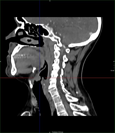 sagittal postcontrast CT images of the neck with similar lesion related to the base of epiglottis, no involvement of the pre epiglottic fat.