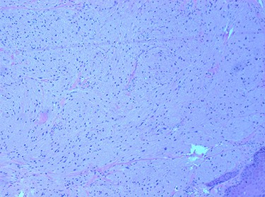 tumour cells with abundant granular cytoplasm and sub-epithelial proliferation. H & E 100×.