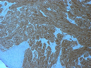 tumour cells staining positive for S-100 on immunohistochemistry.