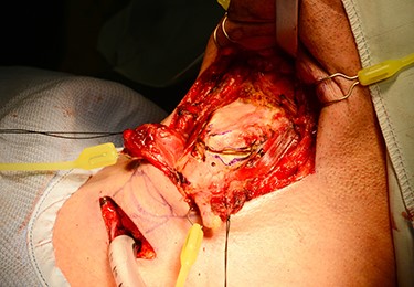 diathermy markings of thyroid cartilage before division. Note existing drill holes placed before resection to aid subsequent closure.