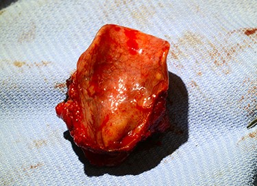 laryngeal surface of supraglottic laryngectomy—specimen for histology. Pale nodular lesion just to right of midline close to inferior margins.