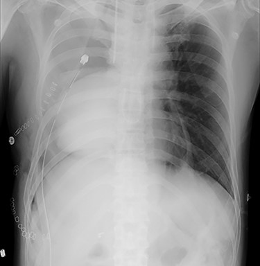 Chest radiography showing cardiac herniation into the right-sided thoracic cavity.
