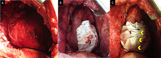 (A) Intraoperative images (at the time of the second operation) showing the patient’s heart is completely herniated into the thoracic cavity. (B) The heart is restored into the pericardium, and complete tearing of sutures is observed on the posterior aspect. (C) Pericardial repair performed by fixing another ePTFE sheet to the defect between the posterior pericardium and the preciously placed ePTFE sheet using horizontal mattress sutures on the posterior aspect (arrows) and a continuous suture between both sheets (arrow head).