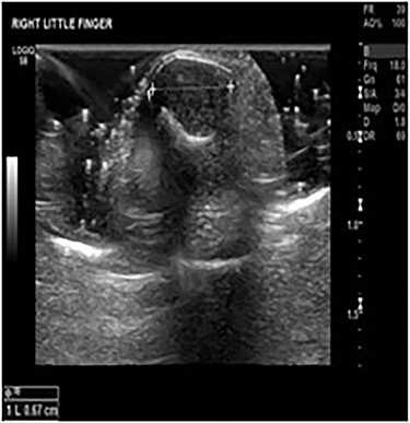 Little finger MSK ultrasound—19 July 2018 ‘16 × 8 × 7 mm’ soft tissue lesion involving the nail bed and wrapping around the terminal phalanx of the right little finger suspicious for a GT.