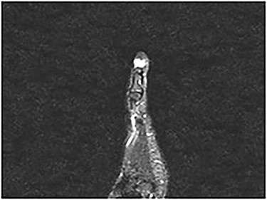 Right hand MRI—19 August 2018 ‘8 × 9 × 10 mm’ hyperintense lesion resulting in pressure erosion and bone remodeling of the distal phalanx keeping with subungual GT.