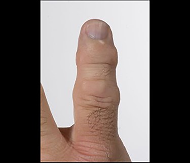 Image demonstrating subcutaneous discoloration and skin changes of the little finger found in our patient.
